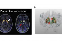 A new method to map the dopamine system in Parkinson’s patients