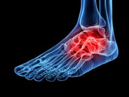 fracture-related infections